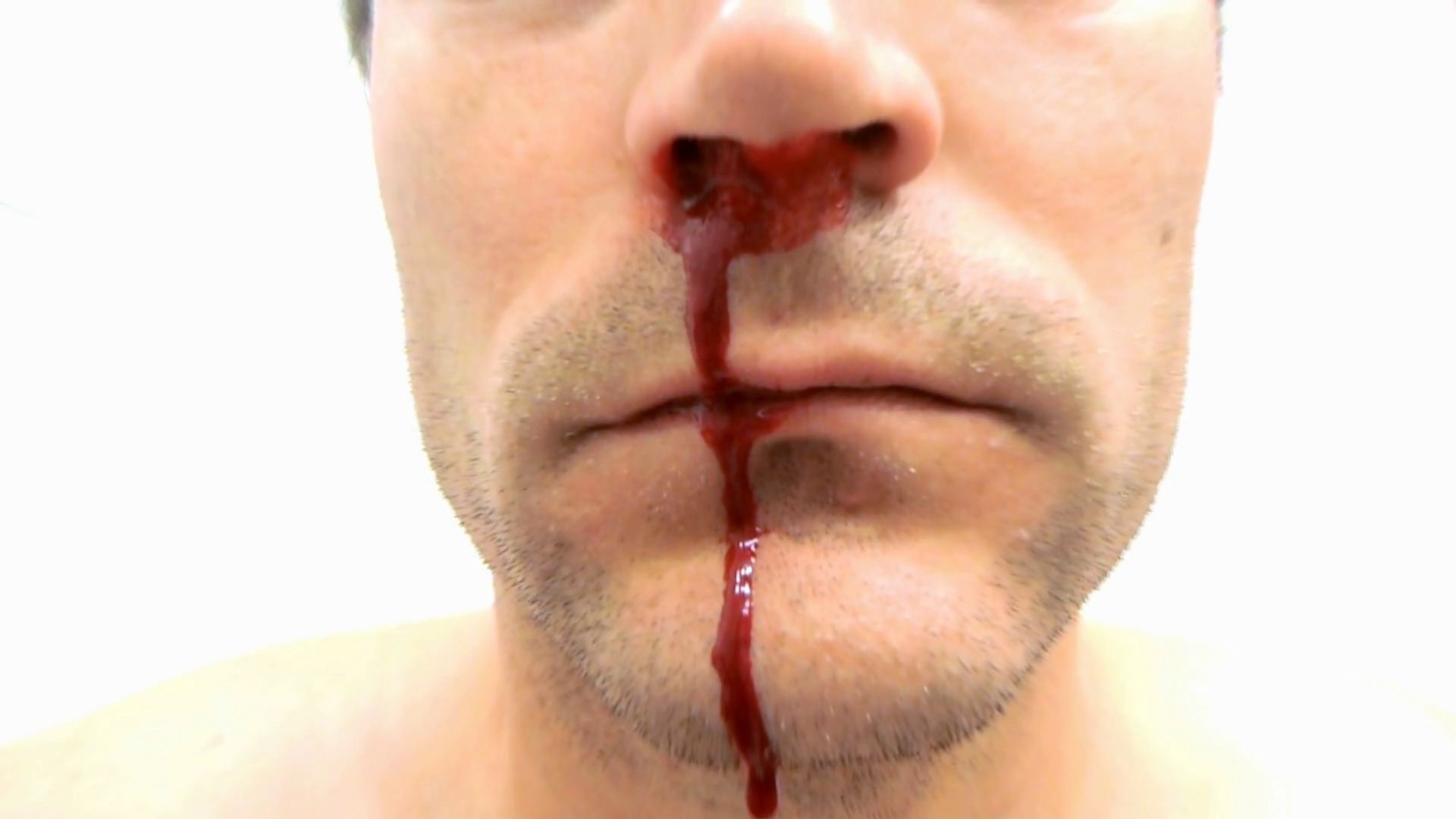 A Man's Nose Dripping With Blood