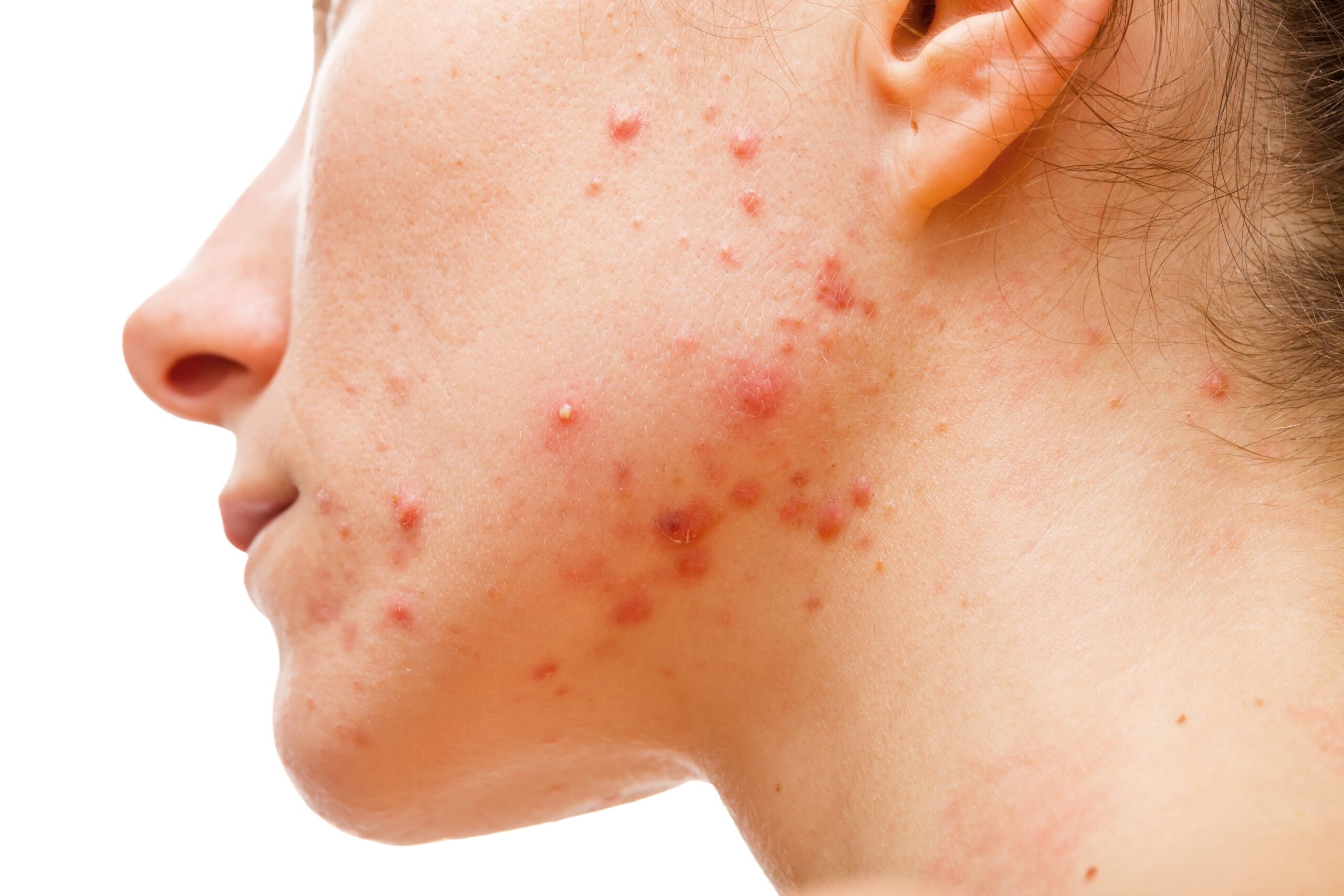 A woman with acne in her cheek and jaw.