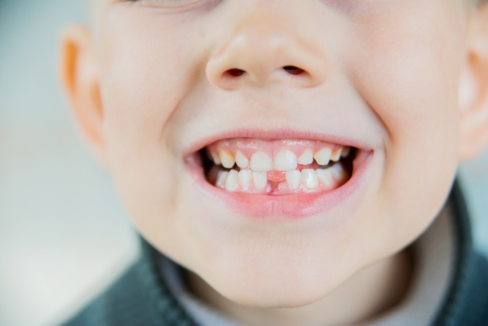 A Boy Smiling Showing His One Tooth Missing